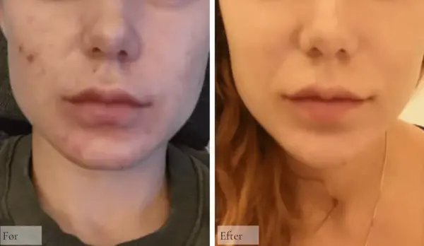 Före och efter bilder visar en hud med hyperpigmentering behandling. Huden är klarare och jämnare efter behandlingen.